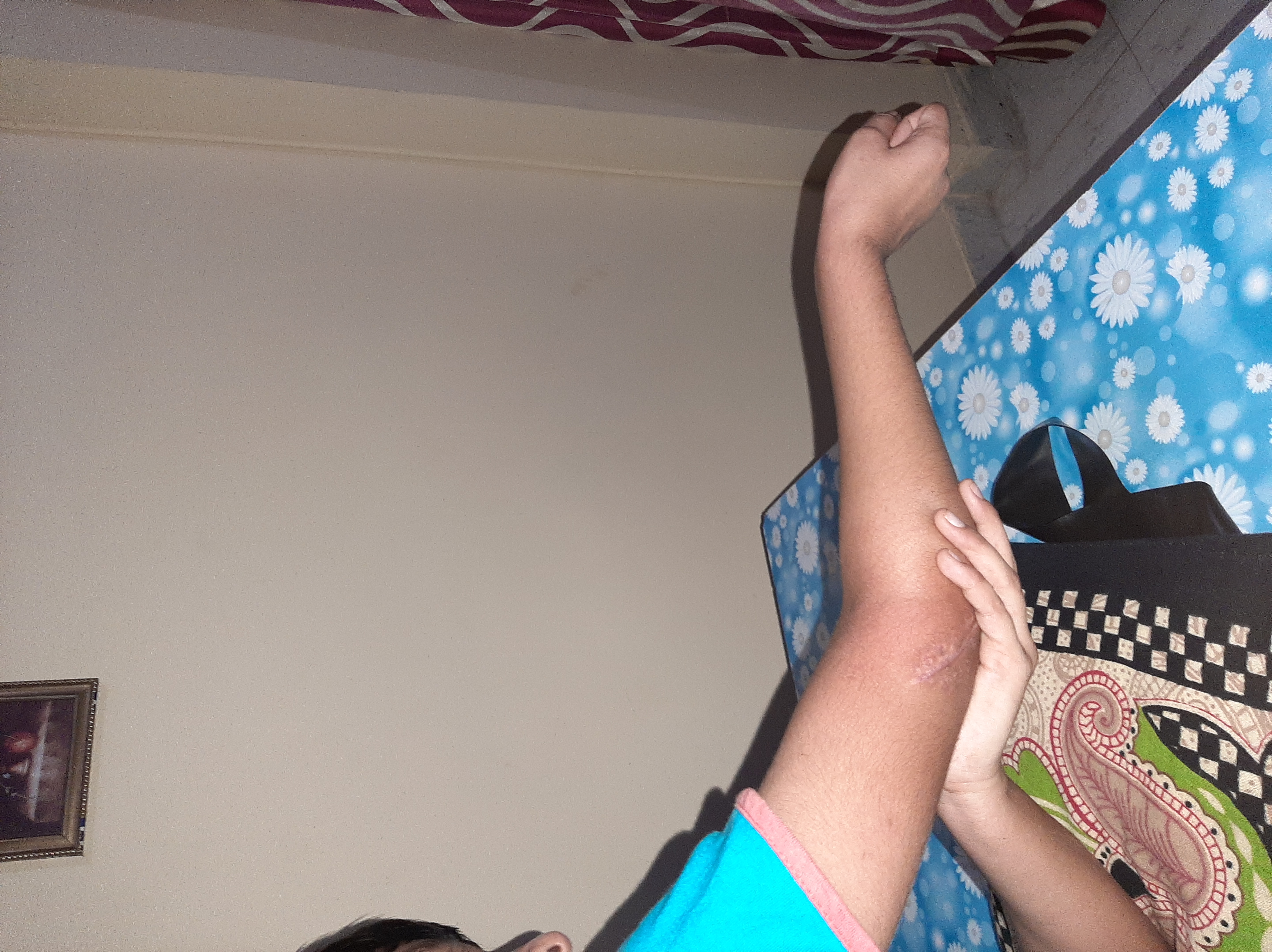 Post fracture rehab