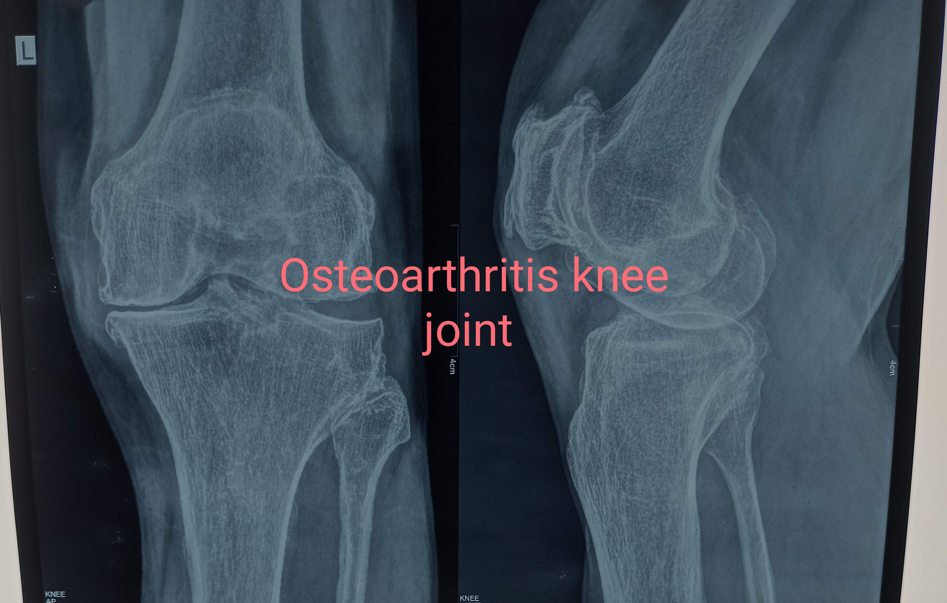 Osteoarthritis knee